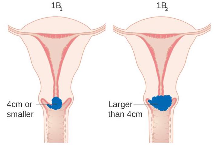 When a colposcopy is needed